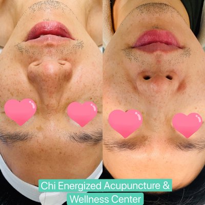 Before and After for one session of deep pore clean facial - ORGANIC DEEP PORE CLEANSING FACIAL
ORGANIC ARCTIC BERRY ADVANCED PEEL FACIAL
ORGANIC YAM & PUMPKIN PRO ENZYME PEEL FACIAL
ORGANIC BAMBOO AGE CORRECTIVE FACIAL
ORGANIC SENSITIVE SKIN CHAMOMILE FACIAL
ORGANIC BRIGHT SKIN PEEL FACIAL