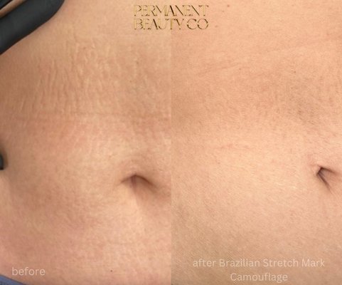 Brazilian stretch mark or scar camouflage - Brazilian Camouflage is a permanent tattoo technique where we match skin colored inks to your skin tone and implement the inks into the skin. This covers the discoloration of stretch marks and scars so they are less visible. Treatment can be done on all skin colors.
Stretch marks must be at least two years old and scars one year.
Up to 50%-100% improvement can be seen in just ONE session, but 2-4 treatments are recommended depending on the area for best results that can last 10+ years!
There is a $100 deposit and pricing varies on location, size, and severity of treated area. Send a photo!
There are over 10,000 inks in the tattoo industry and only 4 inks work for Camouflage. These are the Brazilian inks I use instead of American camouflage pigments. The difference is that pigments change color overtime, and the Brazilian inks have been formulated to not change color even in the sun, they stay the same color we matched to your skin. Best products on the market. Brazilian stretch mark or scar camouflage - Brazilian Camouflage is a permanent tattoo technique where we match skin colored inks to your skin tone and implement the inks into the skin. This covers the discoloration of stretch marks and scars so they are less visible. Treatment can be done on all skin colors.
Stretch marks must be at least two years old and scars one year.
Up to 50%-100% improvement can be seen in just ONE session, but 2-4 treatments are recommended depending on the area for best results that can last 10+ years!
There is a $100 deposit and pricing varies on location, size, and severity of treated area. Send a photo!
There are over 10,000 inks in the tattoo industry and only 4 inks work for Camouflage. These are the Brazilian inks I use instead of American camouflage pigments. The difference is that pigments change color overtime, and the Brazilian inks have been formulated to not change color even in the sun, they stay the same color we matched to your skin. Best products on the market.