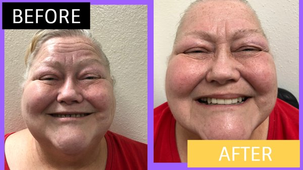 Porcelain Veneer Smile Restoration - This case shows a cosmetic smile restoration completed by Dr. Chuck Le using porcelain veneers. Treatment focused on improving the shape, color, and overall appearance of the patient’s smile while creating a natural-looking result.

The before-and-after photos show the patient’s starting appearance and the completed porcelain veneer restoration. Cosmetic treatment is personalized based on each patient’s dental condition, oral health, and individual goals.