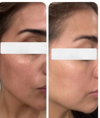 Laser Resurfacing & Hydrinity Skincare - Laser Resurfacing target’s hyperpigmentation, skin tone & texture while increasing collagen production over time 🤍

Combined with medical grade skincare, results are profound !