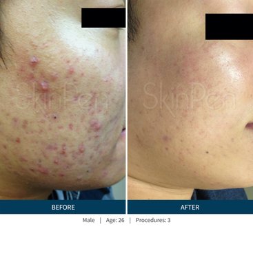 Microneedling with SkinPen® - Microneedling is an excellent treatment option for those seeking to reduce the appearance of acne scars and neck wrinkles. The procedure is painless and requires no downtime. If you’ve been meaning to correct neck wrinkles from years spent outside during the sun, this may be the treatment for you. Individual results may vary. Schedule a consultation with our doctors to see if microneedling is right for your skin. Microneedling with SkinPen® - Microneedling is an excellent treatment option for those seeking to reduce the appearance of acne scars and neck wrinkles. The procedure is painless and requires no downtime. If you’ve been meaning to correct neck wrinkles from years spent outside during the sun, this may be the treatment for you. Individual results may vary. Schedule a consultation with our doctors to see if microneedling is right for your skin.