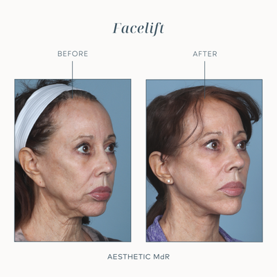 Facelift - A facelift can help address sagging skin, deep wrinkles and creases between the nose and mouth, wrinkles extending from the mouth to your chin, double chin, and issues with excess fat, all in one surgical procedure.
