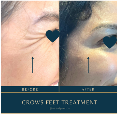 Botox - With our specialized Botox and Xeomin treatments, we want you to feel like the best version of yourself.  Through our conservative yet detailed approach, we're able to reverse the clock gracefully.