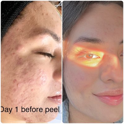 Cystic acne scarring before and after - I found this young woman walking out of a pet store and wondered if I could help her or if she’d even let me. I’m sure there were time where she didn’t think it would get better. But here we are, 8 months later. Minimal scarring and smooth skin. Oh and confidence to go with it! Cystic acne scarring before and after - I found this young woman walking out of a pet store and wondered if I could help her or if she’d even let me. I’m sure there were time where she didn’t think it would get better. But here we are, 8 months later. Minimal scarring and smooth skin. Oh and confidence to go with it!