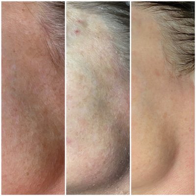 New Skin Transformation Peel System! - Are you ready to change your skin? Our new Elaine Brennan Skin Renewal Peel is transforming faces across Kansas City & yours could be next! This peel system is unlike any other and delivers results in a very short period of time. This system is a 2 part peel performed 6 weeks apart. Most photos show before, after 1st peel & after 2nd peel. Contact us for more information on how you can start your own skin journey today! New Skin Transformation Peel System! - Are you ready to change your skin? Our new Elaine Brennan Skin Renewal Peel is transforming faces across Kansas City & yours could be next! This peel system is unlike any other and delivers results in a very short period of time. This system is a 2 part peel performed 6 weeks apart. Most photos show before, after 1st peel & after 2nd peel. Contact us for more information on how you can start your own skin journey today!