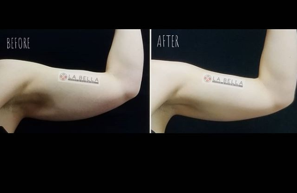 Coolsculpting Medical Aesthetic - Step into a world where your unique desires and needs are met through expert skin care and state-of-the-industry body contouring treatments. La Bella Laser & Slimming is dedicated to providing the latest slimming technologies, non-surgical medical aesthetic procedures, and luxurious beauty treatments with our experienced licensed medical staff and Estheticians.

Coolsculpting® is a revolutionary non-surgical contouring treatment that freezes stubborn fat, which then is naturally eliminated from your body. No needles, no surgery, and most importantly, no downtime. It is safe, FDA-cleared, effective, and does exactly what it’s supposed to do.

The Coolsculpting fat-freezing procedure is the only FDA-cleared, non-surgical fat-reduction treatment that uses controlled cooling to eliminate stubborn fat that resists all efforts through diet and exercise. The results are proven, noticeable, and lasting- so you’ll look great from every angle.

✨FDA-Cleared
✨Non-Surgical
✨Eliminates Fat
✨No down time