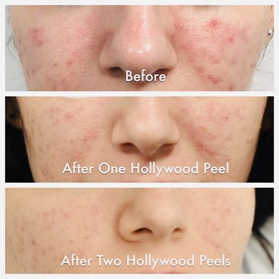 Acne Treatments - Zapatat a special laser treatment that is very effective in eliminating Acne. It called the Spectra Carbon Peel (AKA Hollywood Laser Peel). The Peel is is painless and has no downtime. The treatment kills acne bacteria , lessens oil production and corrects pore blockage. 3 sessions space 3 weeks apart typically is all that needed to eliminate acne. Acne Treatments - Zapatat a special laser treatment that is very effective in eliminating Acne. It called the Spectra Carbon Peel (AKA Hollywood Laser Peel). The Peel is is painless and has no downtime. The treatment kills acne bacteria , lessens oil production and corrects pore blockage. 3 sessions space 3 weeks apart typically is all that needed to eliminate acne.