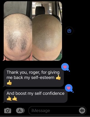 Receded hairline reconstruction - This client came in with a receding hairline and thinning scalp. He saw results immediately. Here’s his before and after photos. You can see results after just 1 session Receded hairline reconstruction - This client came in with a receding hairline and thinning scalp. He saw results immediately. Here’s his before and after photos. You can see results after just 1 session