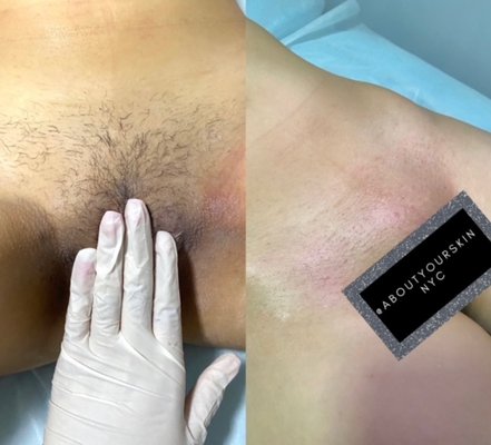 Brazilian Wax - High-quality Brazilian wax services ensure a professional and comfortable experience, employing premium waxes designed to minimize discomfort and maximize efficiency. Expert estheticians meticulously perform these services, prioritizing hygiene, precision, and personalized care to ensure a smooth and long-lasting result. These treatments offer clients a confidence-boosting and hassle-free way to achieve impeccably smooth skin in a comfortable and welcoming environment.