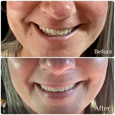 💋 Before & After: Lip Flip Glow-Up - These clients wanted a fuller-looking pout but wasn’t quite ready to jump into lip filler — so we started with a Lip Flip using Daxxify! ✨

By relaxing the muscles around the lips, we created a soft, natural lift that enhances shape without adding volume. It's the perfect way to “test drive” a fuller look before committing to filler. It also softened her marionette lines around her mouth.

And an added perk? Daxxify contains peptides, which can help give the skin a beautiful, subtle glow around the treated area. 🌟

Results are natural, fresh, and confidence-boosting — exactly the look she was going for! So excited to have her visit me at Contour & Sculpt Aesthetics