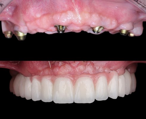 Dental Implants - Missing or damaged teeth? We offer full-service care, from extractions, implant placement, and final restoration. All in one convenient location. Our experienced team uses modern technology to deliver comfortable, precise, and long-lasting results. Schedule a consultation to see if implants are right for you." Dental Implants - Missing or damaged teeth? We offer full-service care, from extractions, implant placement, and final restoration. All in one convenient location. Our experienced team uses modern technology to deliver comfortable, precise, and long-lasting results. Schedule a consultation to see if implants are right for you."