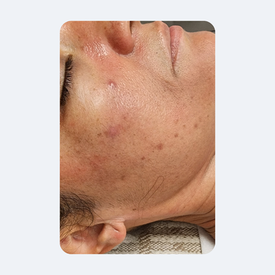 3 SkinPen Treatments - Before and After 3 SkinPen Treatments