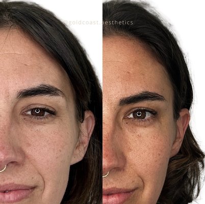 Temple Filler - Temple filler to improve hollowing and restore a youthful appearance to the face! Temple filler also brings the brow tail up for a nice lift! Temple Filler - Temple filler to improve hollowing and restore a youthful appearance to the face! Temple filler also brings the brow tail up for a nice lift!