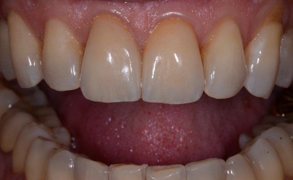 New front teeth - This patient was unhappy with his old, unnatural-looking crowns on his two front teeth. We replaced them with beautifully crafted Emax crowns for a more natural and aesthetically pleasing appearance.