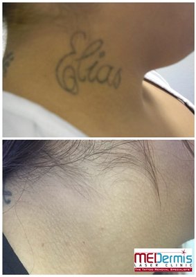 Neck and Face - Before & After Pix - All of these removal were performed at MEDermis Tattoo Removal. The number of treatments will vary from tattoo to tattoo, person to person. Schedule a consultation to learn more about what we can do for you. Neck and Face - Before & After Pix - All of these removal were performed at MEDermis Tattoo Removal. The number of treatments will vary from tattoo to tattoo, person to person. Schedule a consultation to learn more about what we can do for you.
