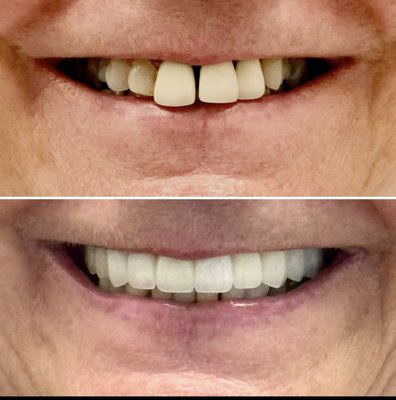 Before & Afters - These pictures show some of our latest smile makeovers. Call us for a Free consultation ! Before & Afters - These pictures show some of our latest smile makeovers. Call us for a Free consultation !