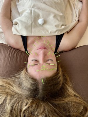 Cosmetic Acupuncture - Our Cosmetic Acupuncture treatment naturally lifts, tones, and revitalizes your skin. Gentle facial needles stimulate collagen and circulation, softening fine lines and improving elasticity. Facial cupping and gua sha release tension, sculpt contours, and promote lymphatic drainage, while Celluma red light therapy supports cellular rejuvenation for a radiant glow. This deeply relaxing session restores balance inside and out, leaving you feeling refreshed, lifted, and luminous. Cosmetic Acupuncture - Our Cosmetic Acupuncture treatment naturally lifts, tones, and revitalizes your skin. Gentle facial needles stimulate collagen and circulation, softening fine lines and improving elasticity. Facial cupping and gua sha release tension, sculpt contours, and promote lymphatic drainage, while Celluma red light therapy supports cellular rejuvenation for a radiant glow. This deeply relaxing session restores balance inside and out, leaving you feeling refreshed, lifted, and luminous.
